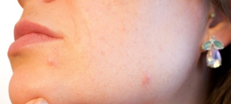 The Danger Of Pore Strips