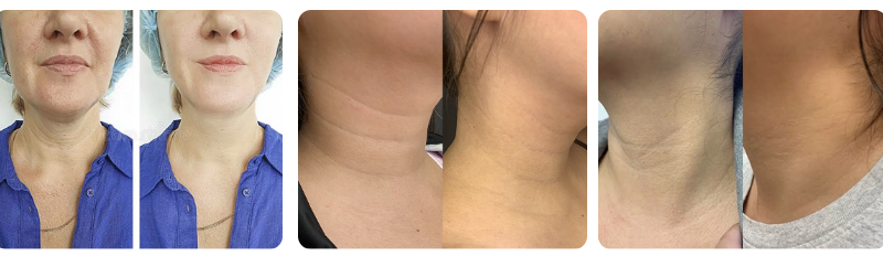 Neck Wrinkles: Easiest to Prevent. Hardest to Treat.
